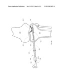 COMBINATION DIRECTIONAL AND NON-DIRECTIONAL BONE TAMP diagram and image