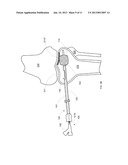 COMBINATION DIRECTIONAL AND NON-DIRECTIONAL BONE TAMP diagram and image