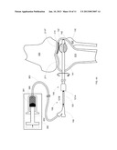 COMBINATION DIRECTIONAL AND NON-DIRECTIONAL BONE TAMP diagram and image