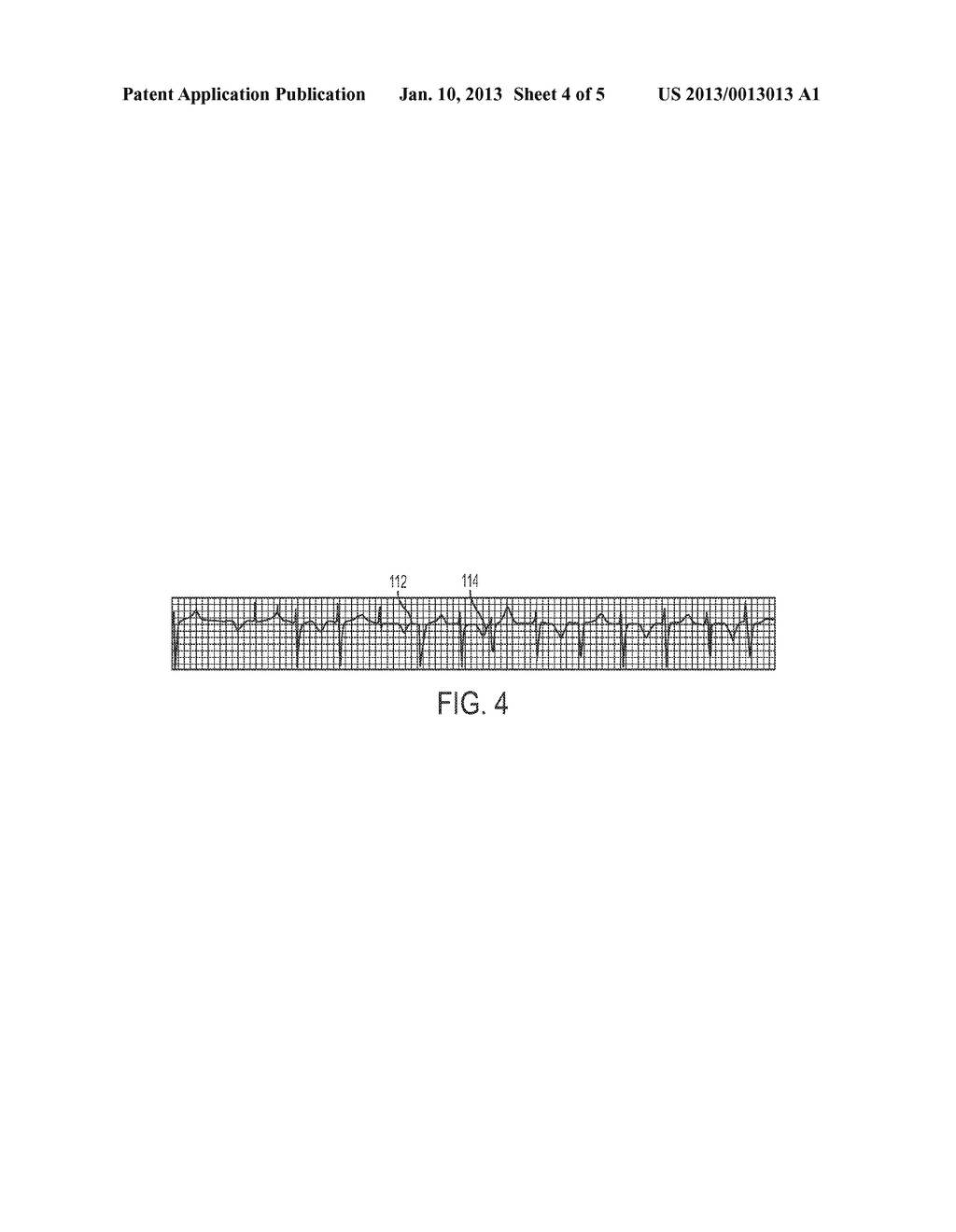 METHOD AND APPARATUS FOR TREATMENT OF CARDIAC TACHYARRHYTHMIAS - diagram, schematic, and image 05