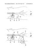 Renal Nerve Stimulation Method for Treatment of Patients diagram and image