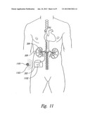 Renal Nerve Stimulation Method for Treatment of Patients diagram and image