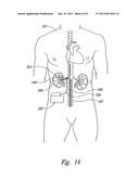 Renal Nerve Stimulation Method for Treatment of Patients diagram and image