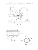 Renal Nerve Stimulation Method for Treatment of Patients diagram and image