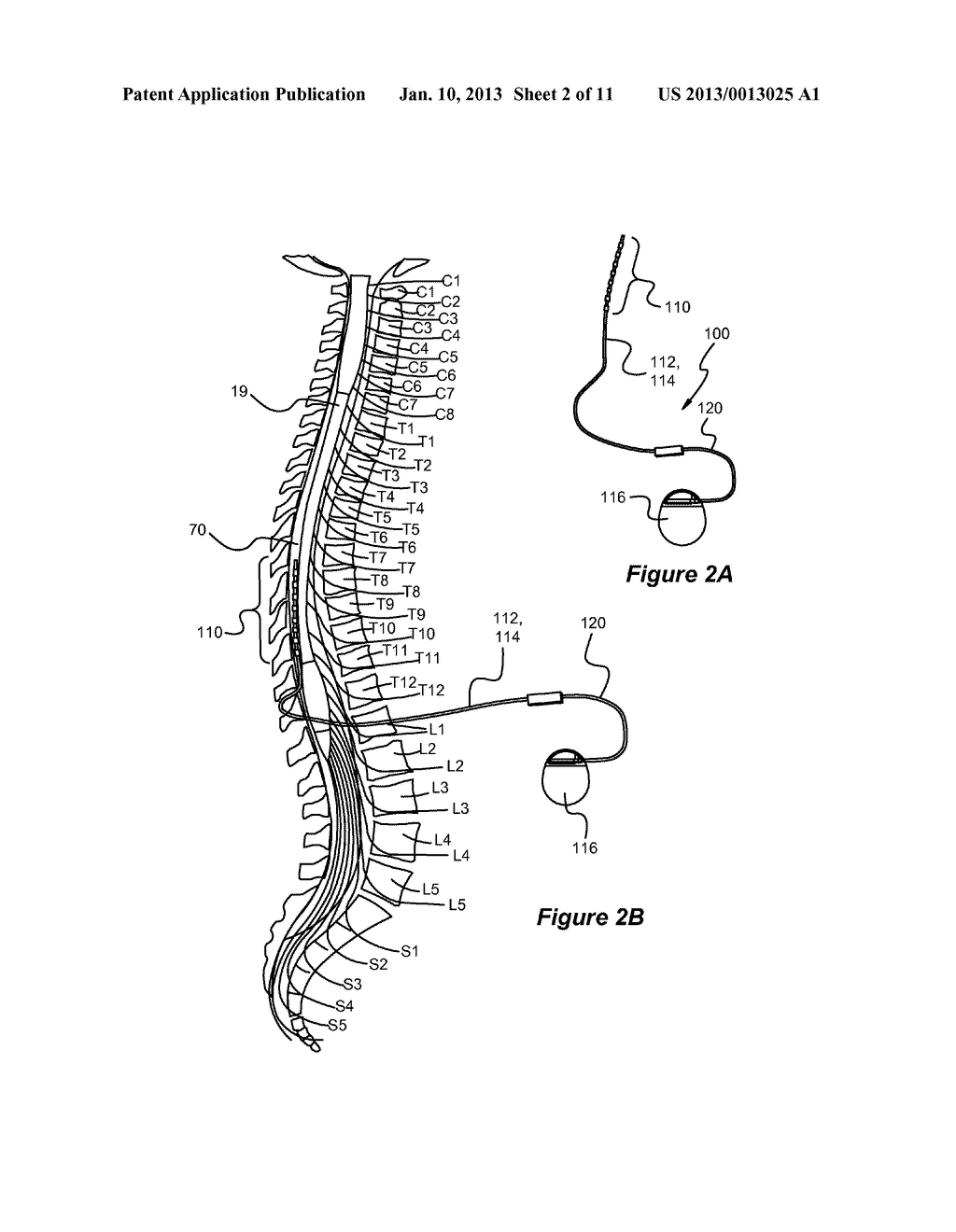 Fractionalized Stimulation Pulses in an Implantable Stimulator Device - diagram, schematic, and image 03