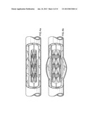 MULTIPLE DRUG DELIVERY FROM A BALLOON AND A PROSTHESIS diagram and image