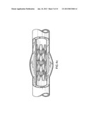 MULTIPLE DRUG DELIVERY FROM A BALLOON AND A PROSTHESIS diagram and image