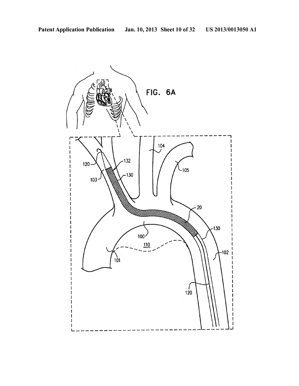 MULTI-COMPONENT STENT-GRAFT SYSTEM FOR IMPLANTATION IN A BLOOD VESSEL WITH     MULTIPLE BRANCHES - diagram, schematic, and image 11