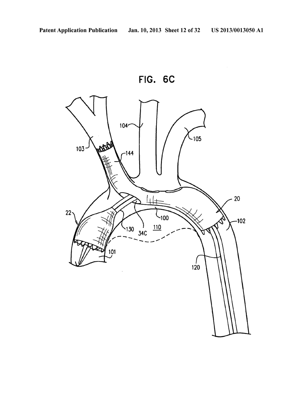 MULTI-COMPONENT STENT-GRAFT SYSTEM FOR IMPLANTATION IN A BLOOD VESSEL WITH     MULTIPLE BRANCHES - diagram, schematic, and image 13