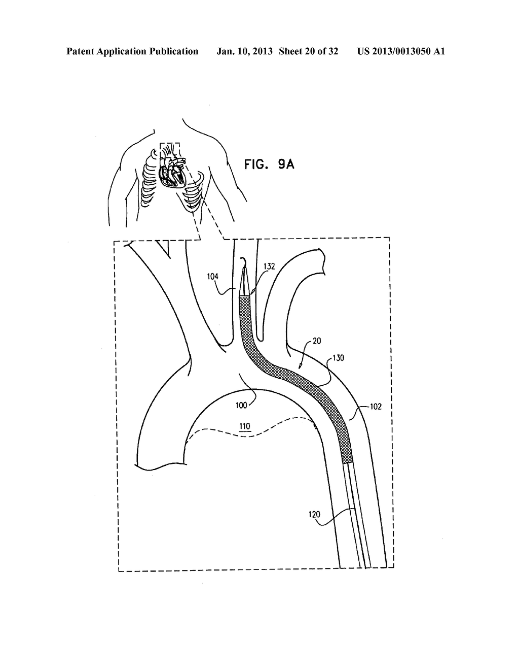 MULTI-COMPONENT STENT-GRAFT SYSTEM FOR IMPLANTATION IN A BLOOD VESSEL WITH     MULTIPLE BRANCHES - diagram, schematic, and image 21