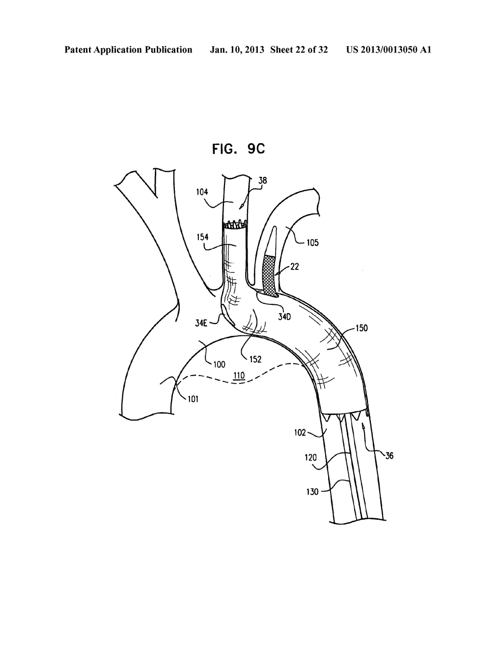 MULTI-COMPONENT STENT-GRAFT SYSTEM FOR IMPLANTATION IN A BLOOD VESSEL WITH     MULTIPLE BRANCHES - diagram, schematic, and image 23