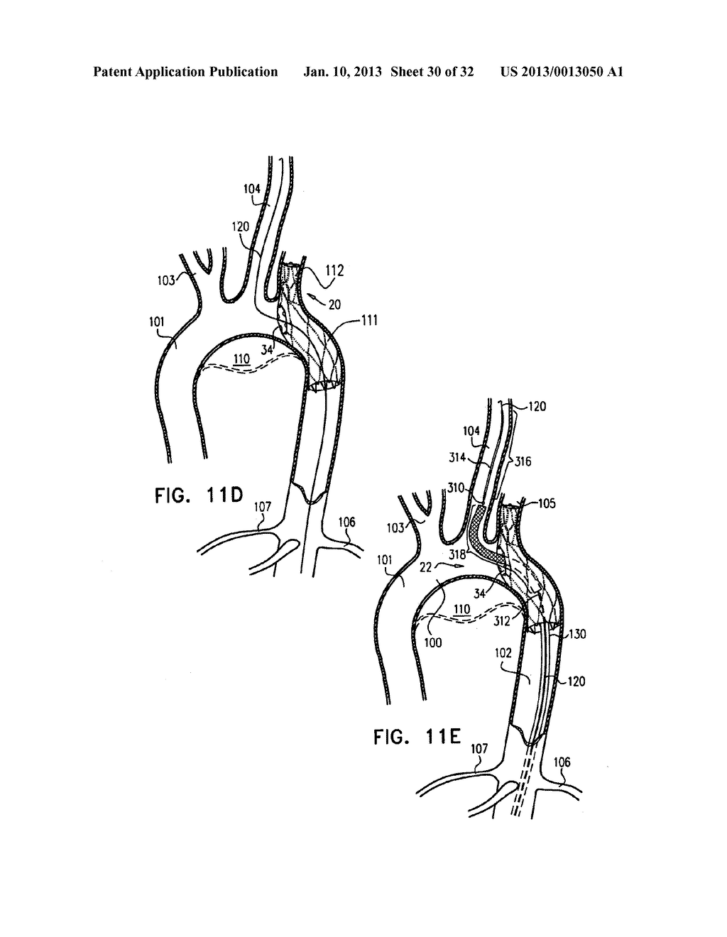 MULTI-COMPONENT STENT-GRAFT SYSTEM FOR IMPLANTATION IN A BLOOD VESSEL WITH     MULTIPLE BRANCHES - diagram, schematic, and image 31