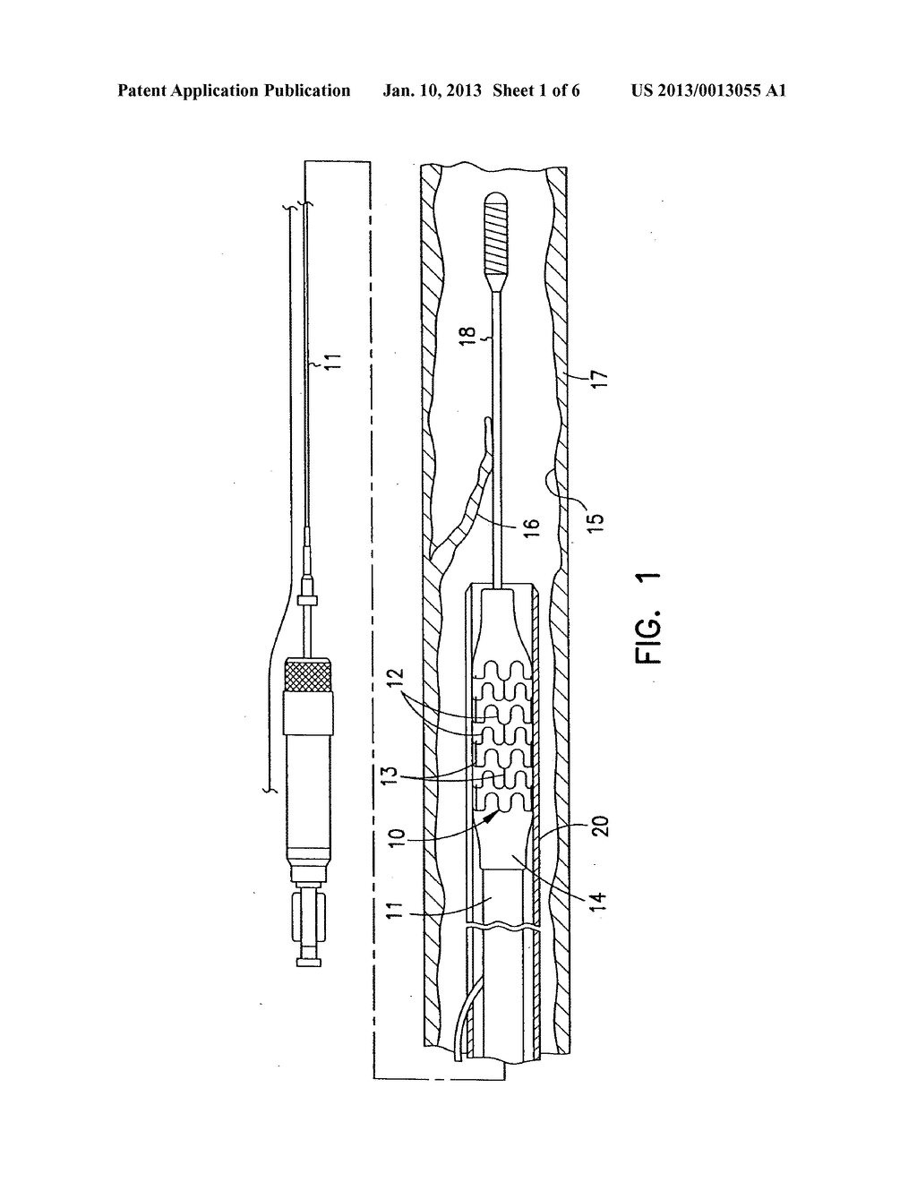 RADIOPAQUE INTRALUMINAL STENT - diagram, schematic, and image 02