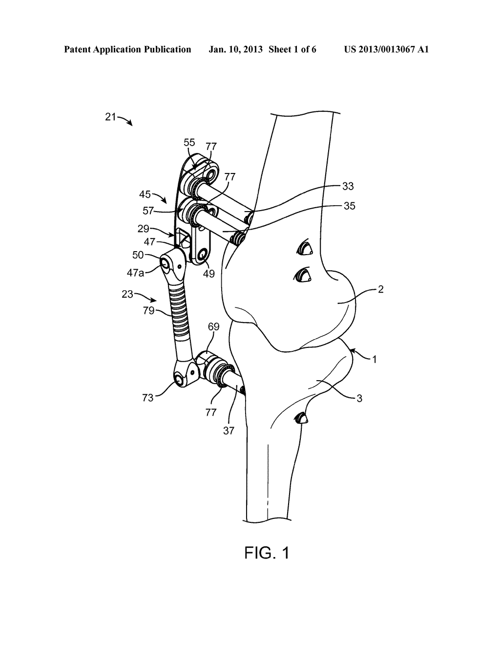 Transcutaneous Joint Unloading Device and Method - diagram, schematic, and image 02