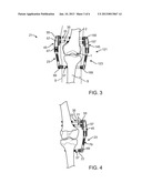 Transcutaneous Joint Unloading Device and Method diagram and image