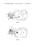 Transcutaneous Joint Unloading Device and Method diagram and image