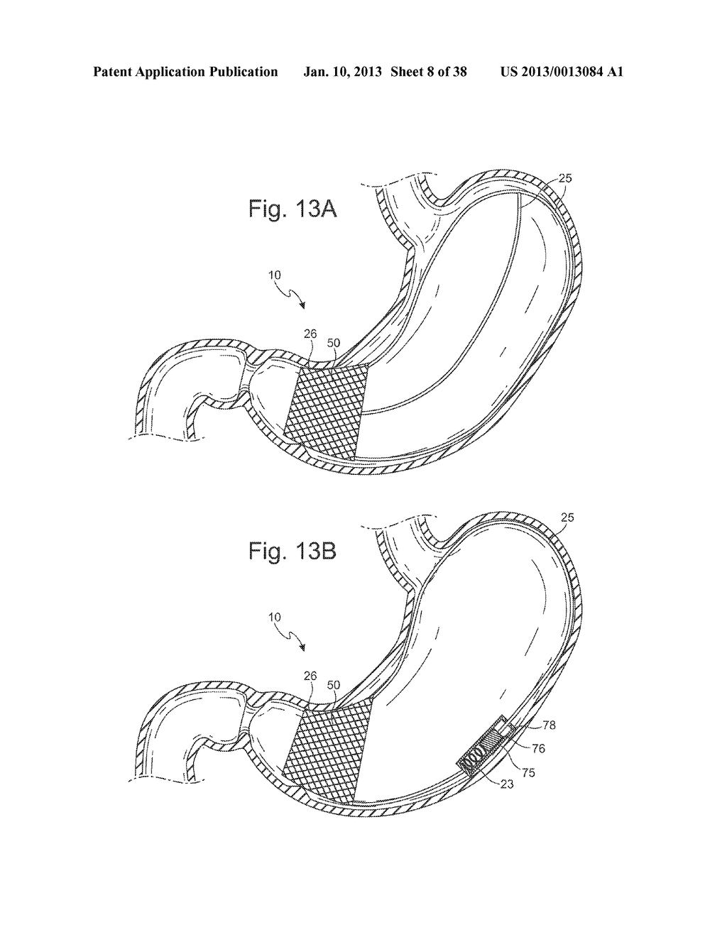 BARIATRIC DEVICE AND METHOD FOR WEIGHT LOSS - diagram, schematic, and image 09