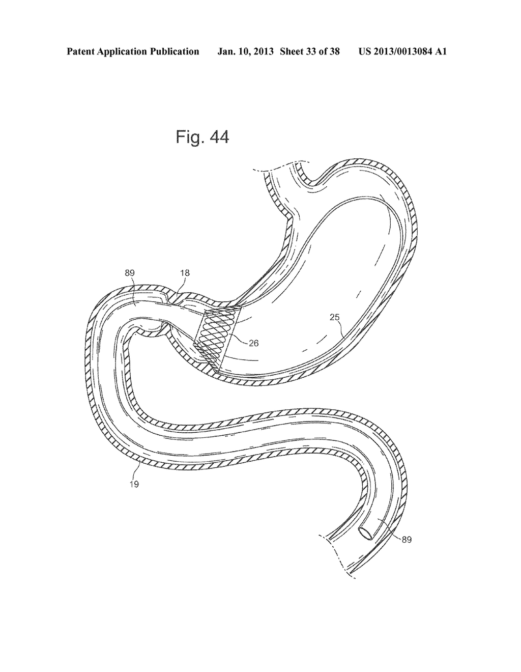 BARIATRIC DEVICE AND METHOD FOR WEIGHT LOSS - diagram, schematic, and image 34