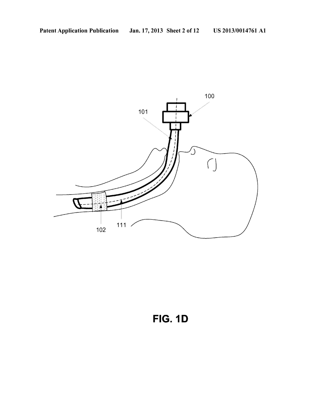 ENDOTRACHEAL TUBE HAVING ONE OR MORE BLOCKING ELEMENTS, BLOCKING ELEMENTS,     AND A METHOD OF USING BLOCKING ELEMENTS - diagram, schematic, and image 03