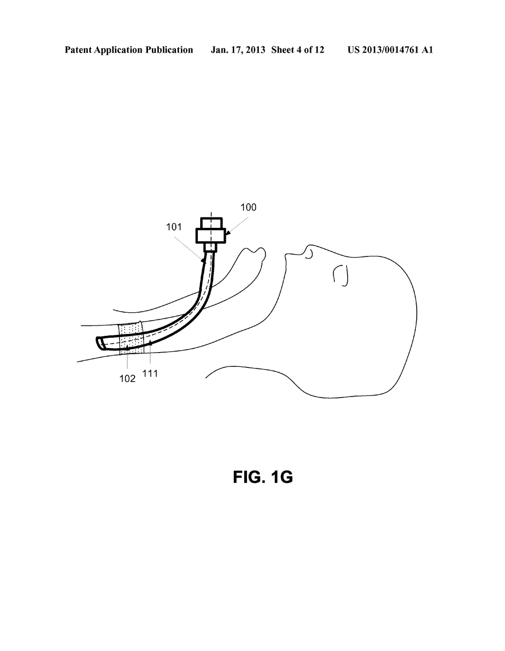 ENDOTRACHEAL TUBE HAVING ONE OR MORE BLOCKING ELEMENTS, BLOCKING ELEMENTS,     AND A METHOD OF USING BLOCKING ELEMENTS - diagram, schematic, and image 05