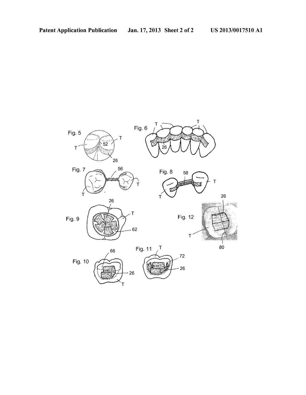 FIBER REINFORCED DENTAL APPLIANCES AND PROSTHESES - diagram, schematic, and image 03