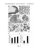 ADAM12 AS A BIOMARKER FOR BLADDER CANCER diagram and image