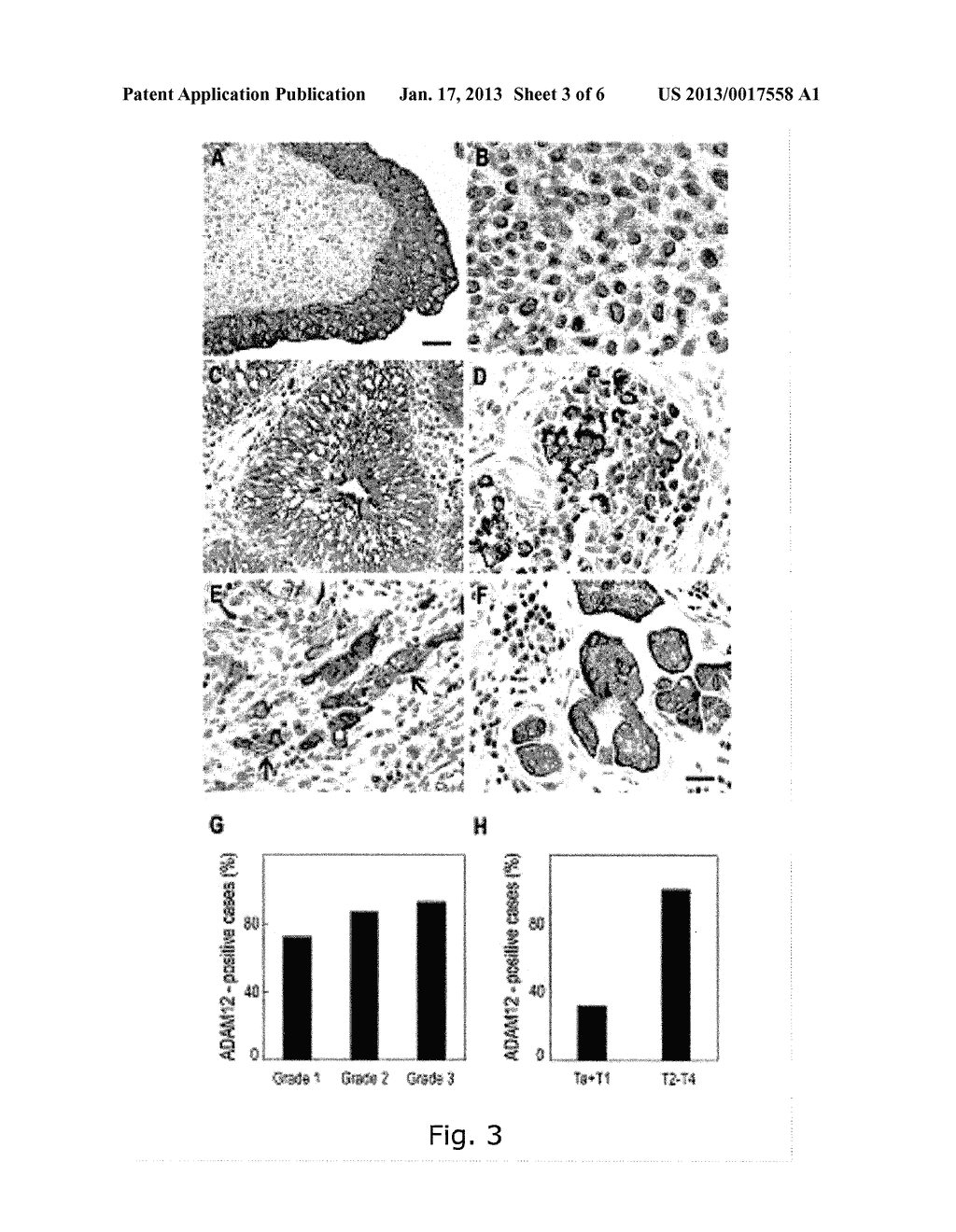 ADAM12 AS A BIOMARKER FOR BLADDER CANCER - diagram, schematic, and image 04