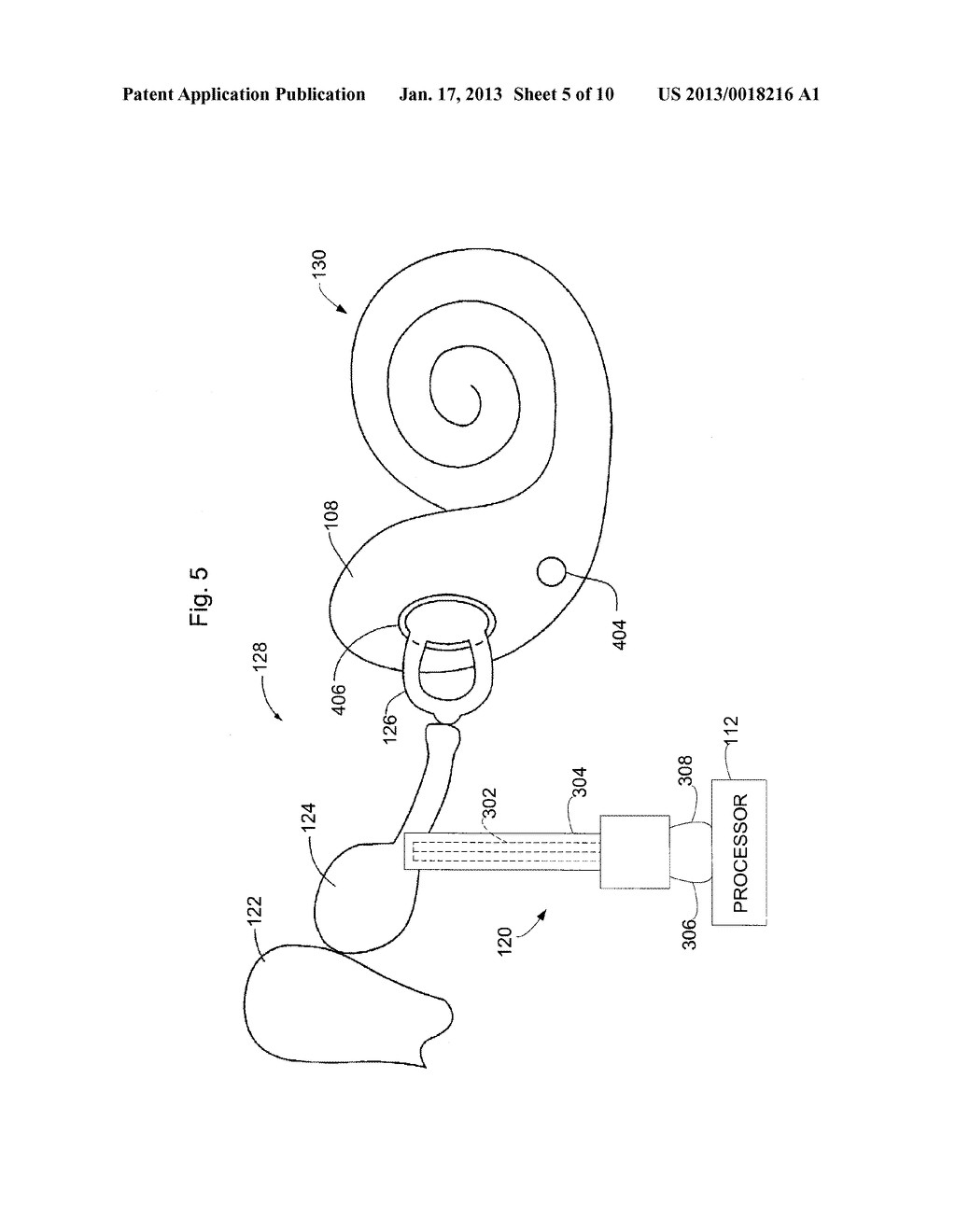 FULLY-IMPLANTABLE MICROPHONELESS COCHLEAR IMPLANT - diagram, schematic, and image 06