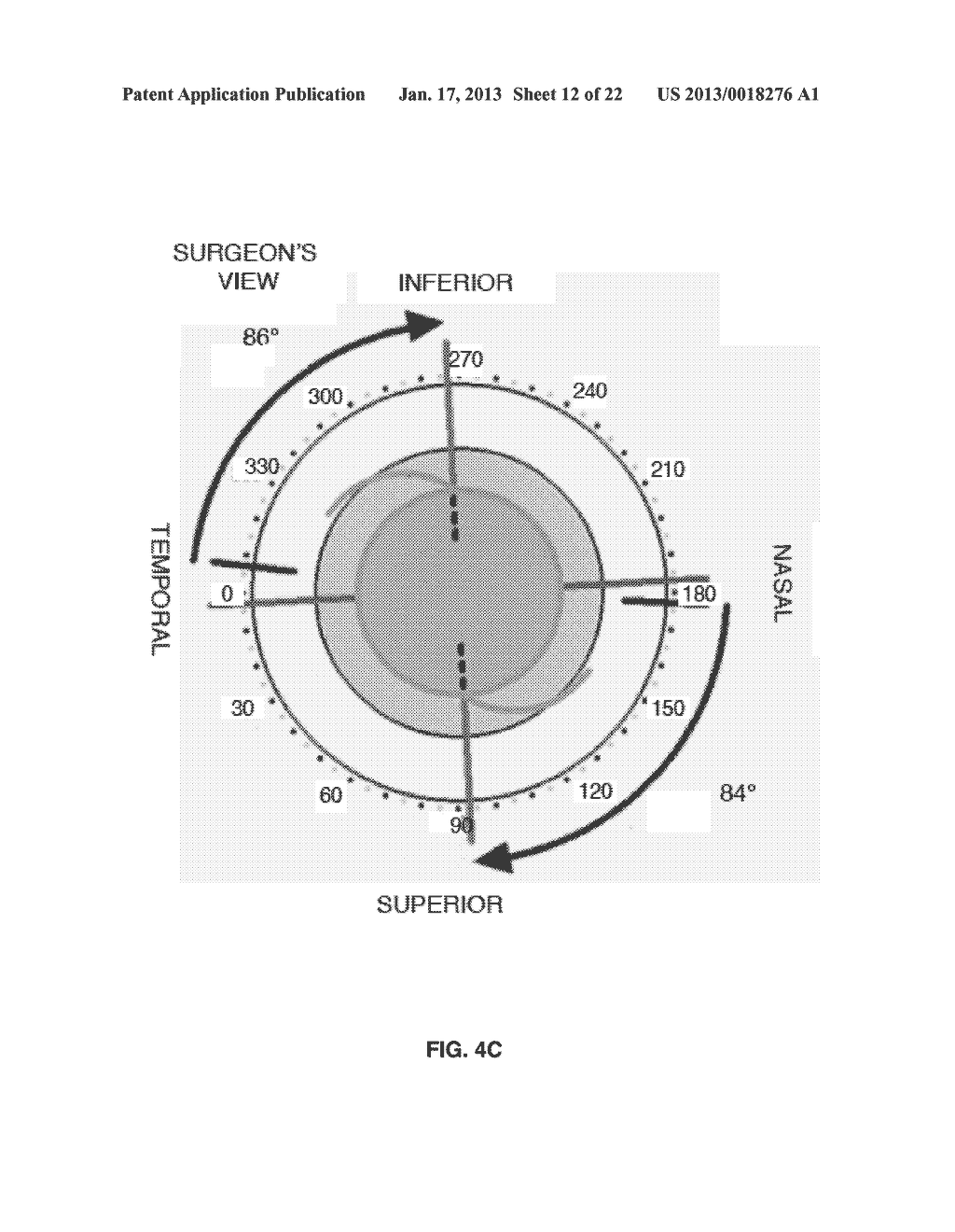 Tools and methods for the surgical placement of intraocular implants - diagram, schematic, and image 13