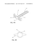 TEAR-AWAY SHEATH WITH INTEGRAL STOP diagram and image