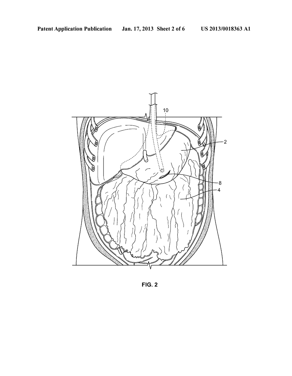 METHODS AND DEVICES FOR REMOVING OMENTAL TISSUE - diagram, schematic, and image 03