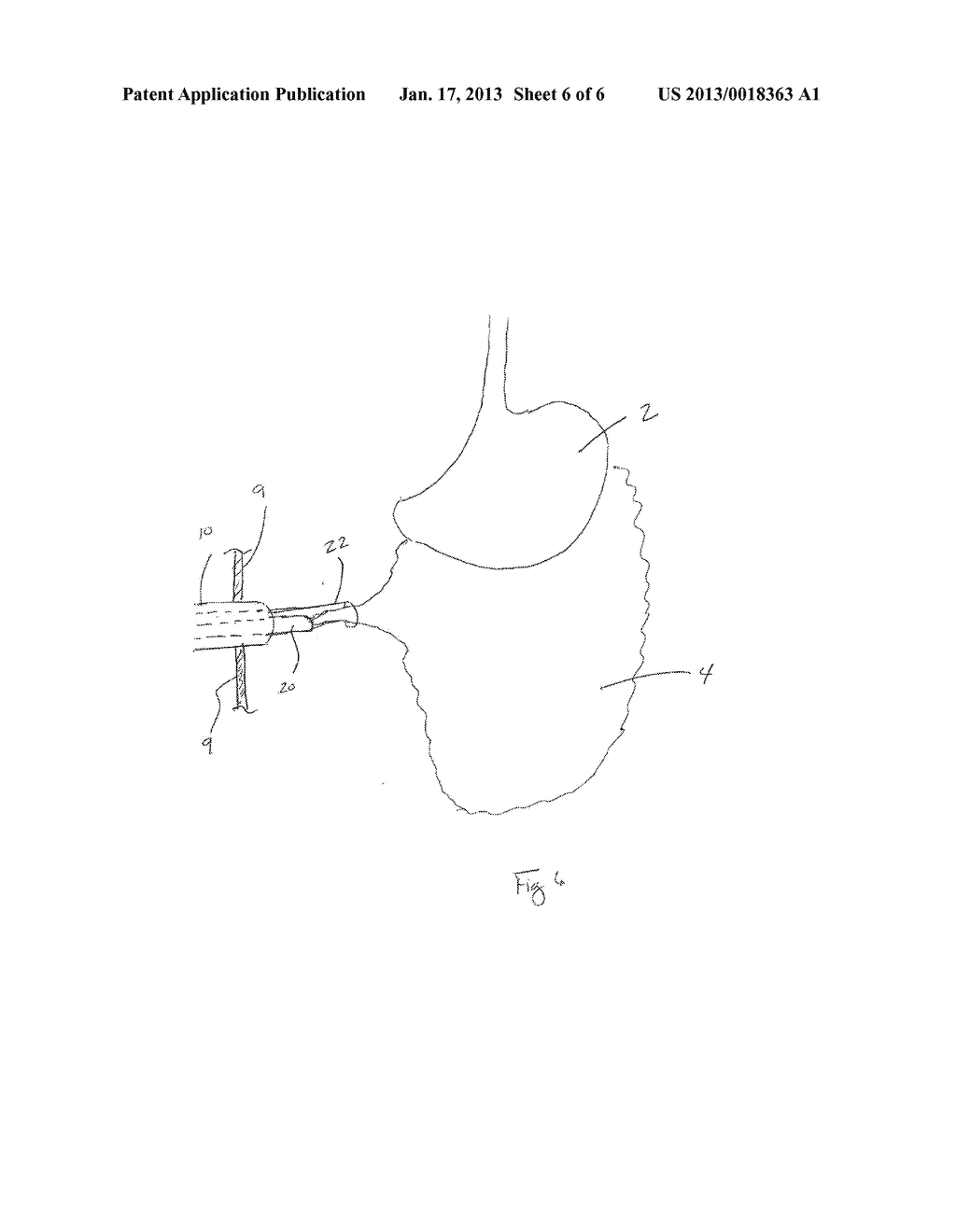 METHODS AND DEVICES FOR REMOVING OMENTAL TISSUE - diagram, schematic, and image 07