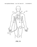 SYSTEMS AND METHODS FOR TREATMENT IN PROXIMITY TO SENSITIVE TISSUE     STRUCTURESAANM MIHALIK; Teresa AnnAACI EncinitasAAST CAAACO USAAGP MIHALIK; Teresa Ann Encinitas CA US diagram and image