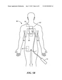 SYSTEMS AND METHODS FOR TREATMENT IN PROXIMITY TO SENSITIVE TISSUE     STRUCTURESAANM MIHALIK; Teresa AnnAACI EncinitasAAST CAAACO USAAGP MIHALIK; Teresa Ann Encinitas CA US diagram and image