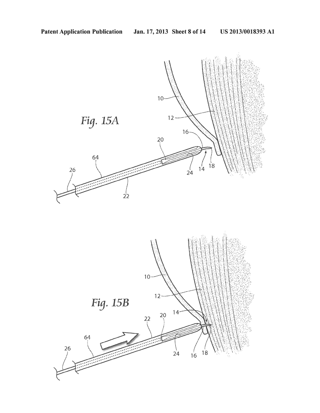 SURGICAL FIXATION DEVICES, SYSTEMS, AND METHODS - diagram, schematic, and image 09