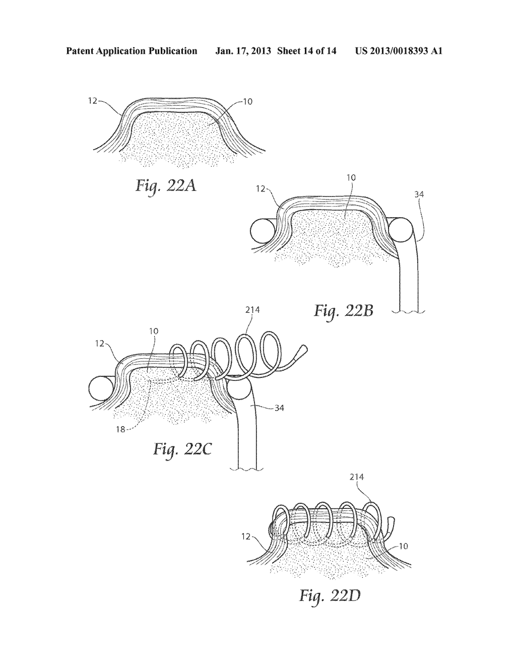 SURGICAL FIXATION DEVICES, SYSTEMS, AND METHODS - diagram, schematic, and image 15