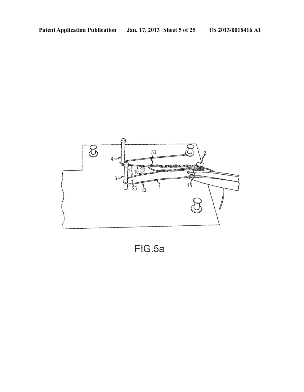 SOFT SUTURE ANCHOR MADE OF BRAIDED OR MONOFILAMENT SUTURE - diagram, schematic, and image 06