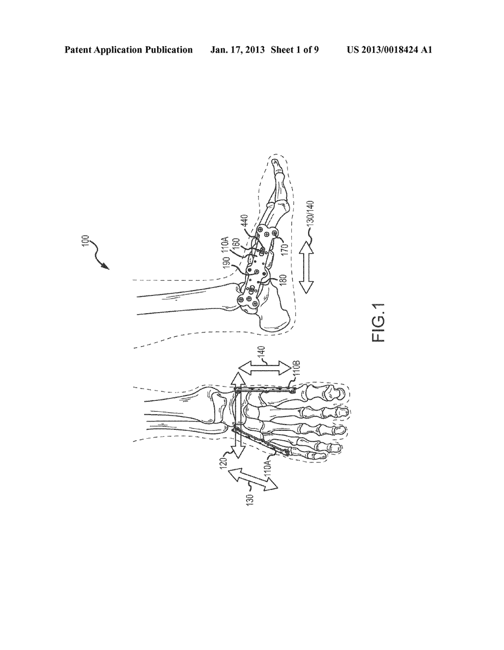 OSTEOTOMY AND ARTHRODESIS TREATMENT SYSTEMAANM Subik; MichaelAACI Atlantic HighlandsAAST NJAACO USAAGP Subik; Michael Atlantic Highlands NJ US - diagram, schematic, and image 02