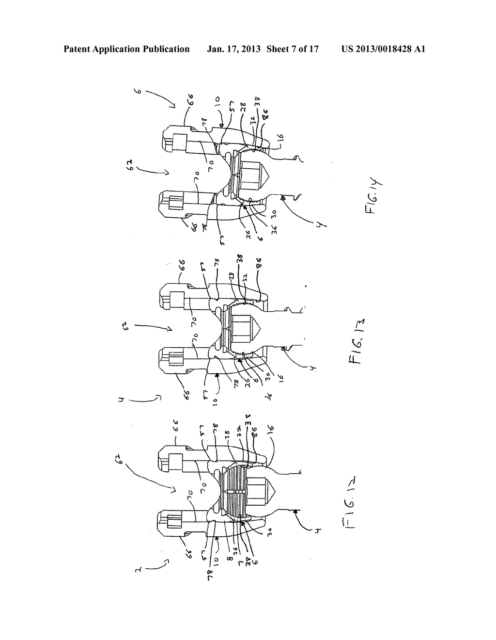 Orthopedic Fixation Devices and Methods of Installation ThereofAANM Harper; MichaelAACI PottstownAAST PAAACO USAAGP Harper; Michael Pottstown PA USAANM George; MilanAACI King of PrussiaAAST PAAACO USAAGP George; Milan King of Prussia PA USAANM Manninen; KatherineAACI LimerickAAST PAAACO USAAGP Manninen; Katherine Limerick PA USAANM Perkins; JohnAACI PottstownAAST PAAACO USAAGP Perkins; John Pottstown PA US - diagram, schematic, and image 08