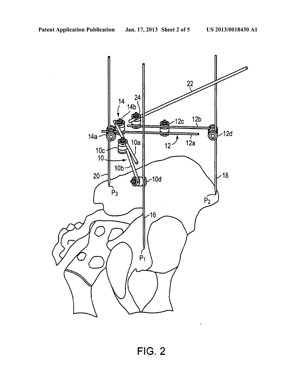 METHOD AND APPARATUS FOR DETERMINING ACETABULAR COMPONENT POSITIONING - diagram, schematic, and image 03