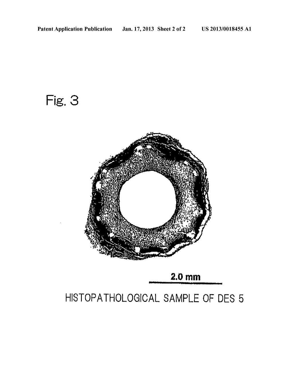 METHOD OF INHIBITING VASCULAR INTIMAL HYPERPLASIA USING STENT - diagram, schematic, and image 03