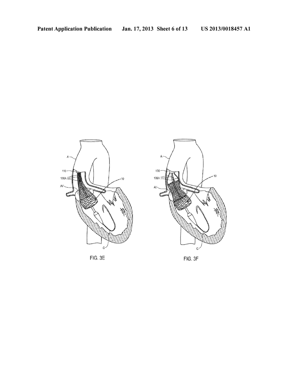 Coupling System for Medical Devices - diagram, schematic, and image 07