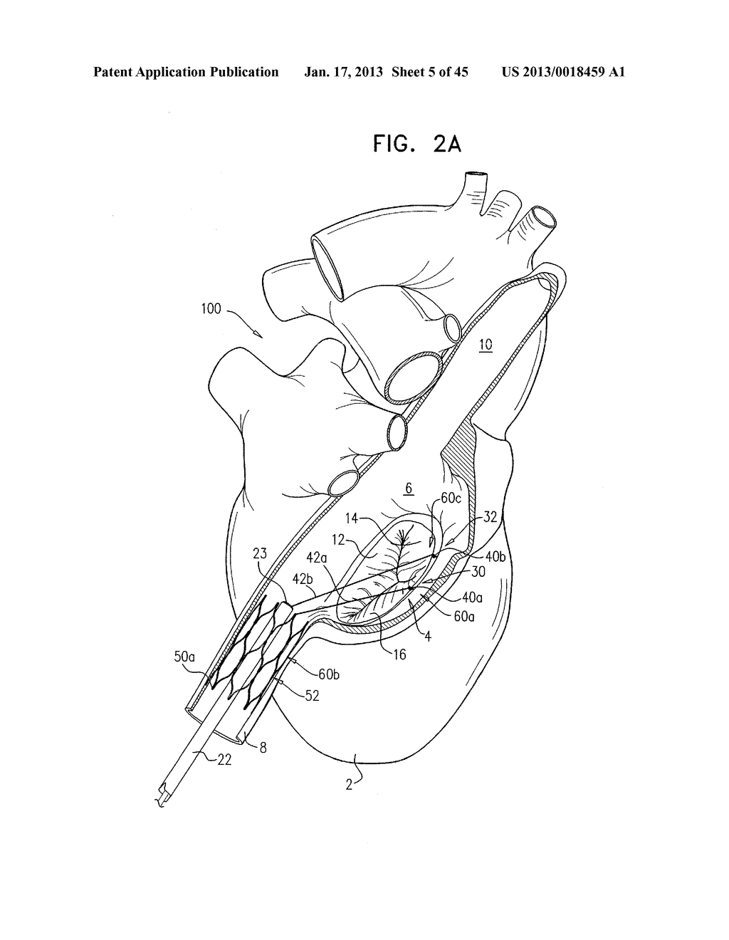 METHOD AND APPARATUS FOR TRICUSPID VALVE REPAIR USING TENSION - diagram, schematic, and image 06