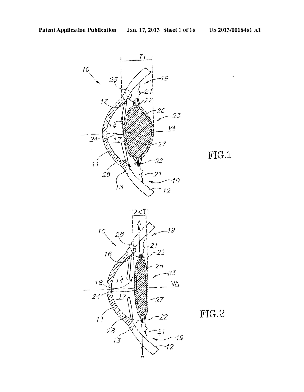 Foldable Accommodating Intraocular Lens - diagram, schematic, and image 02