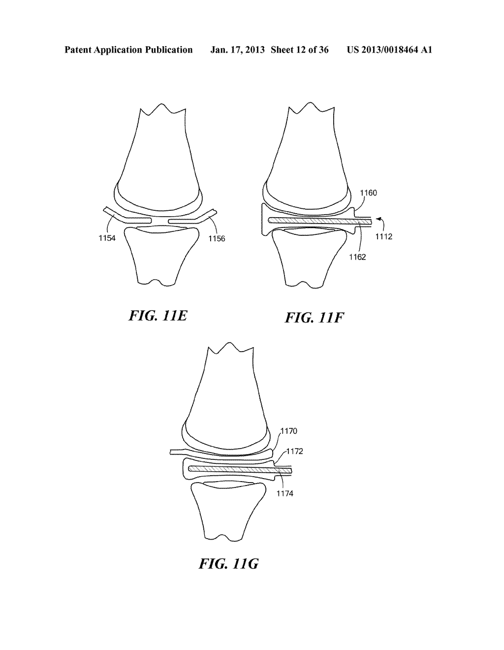 JOINT ARTHROPLASTY DEVICES AND SURGICAL TOOLS - diagram, schematic, and image 13