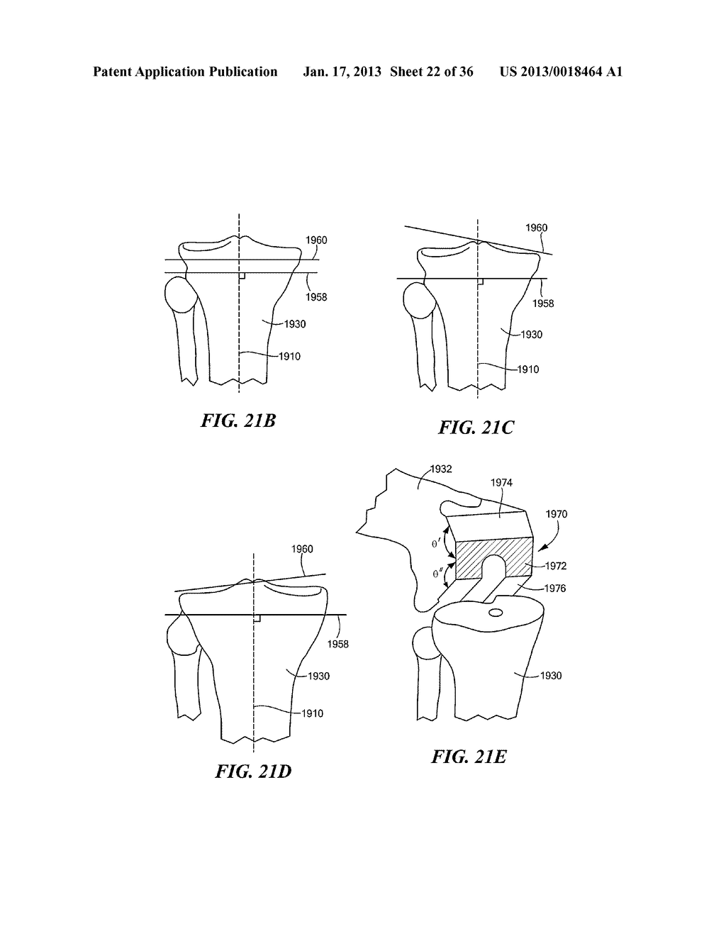 JOINT ARTHROPLASTY DEVICES AND SURGICAL TOOLS - diagram, schematic, and image 23