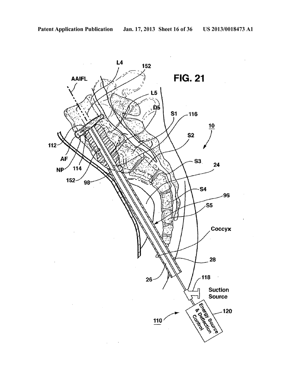 METHODS AND APPARATUS FOR PERFORMING THERAPEUTIC PROCEDURES IN THE SPINE - diagram, schematic, and image 17