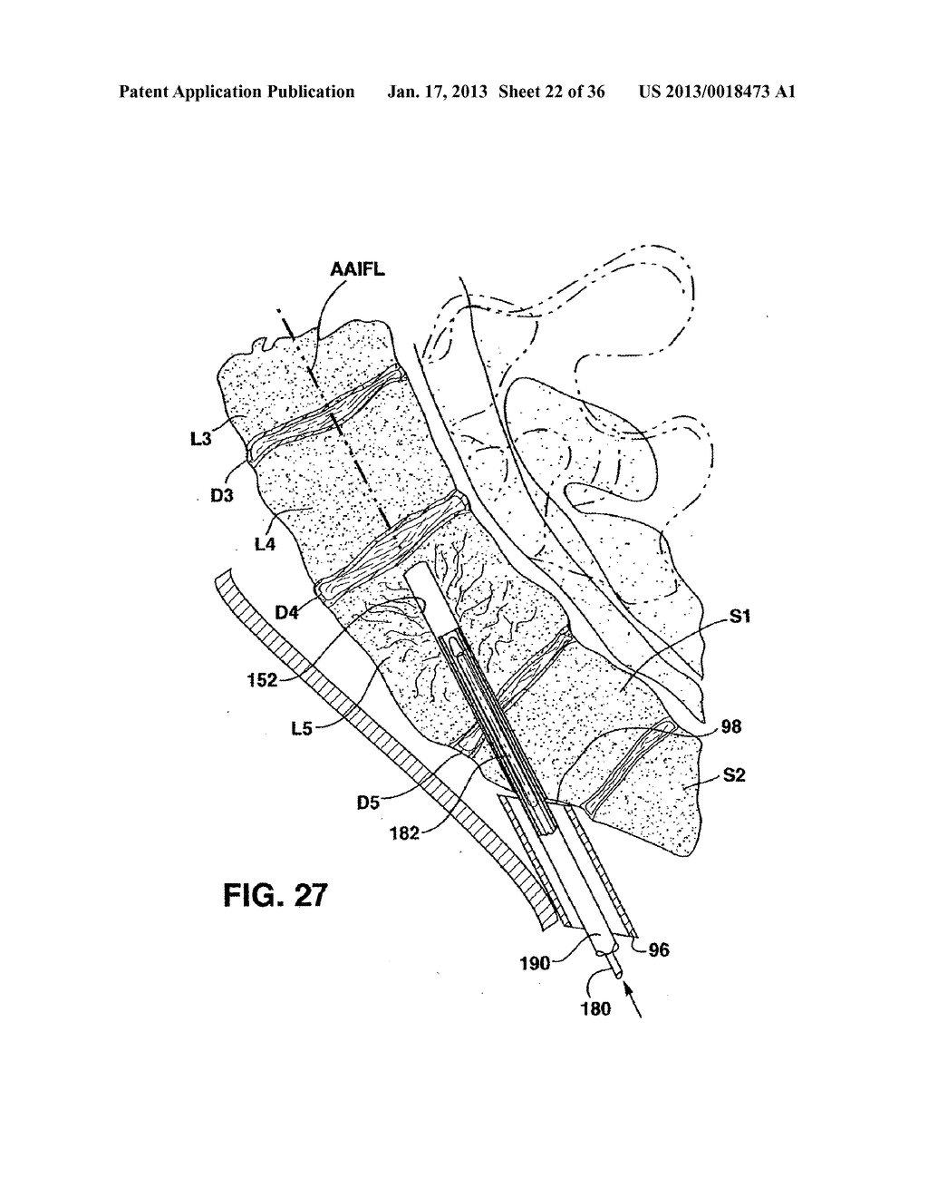 METHODS AND APPARATUS FOR PERFORMING THERAPEUTIC PROCEDURES IN THE SPINE - diagram, schematic, and image 23