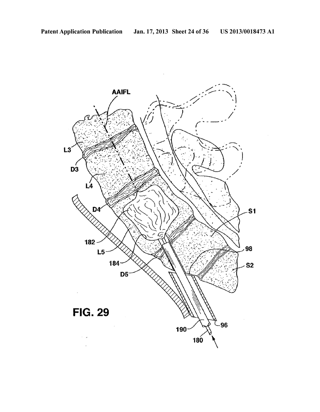 METHODS AND APPARATUS FOR PERFORMING THERAPEUTIC PROCEDURES IN THE SPINE - diagram, schematic, and image 25