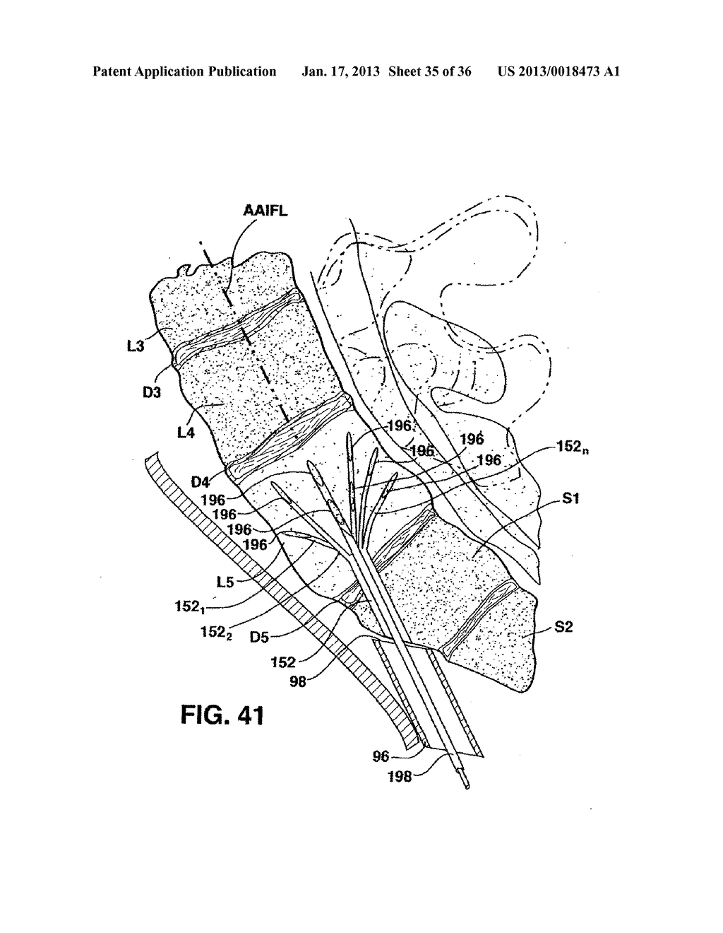 METHODS AND APPARATUS FOR PERFORMING THERAPEUTIC PROCEDURES IN THE SPINE - diagram, schematic, and image 36